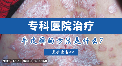 ?？漆t院治療牛皮癬的方法是什么