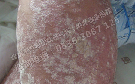 患上銀屑病怎么治治療效果果可以