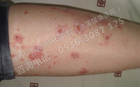濰坊治療牛皮癬的可以醫院