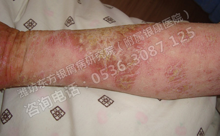 怎樣才能降低銀屑病發(fā)生的幾率呢