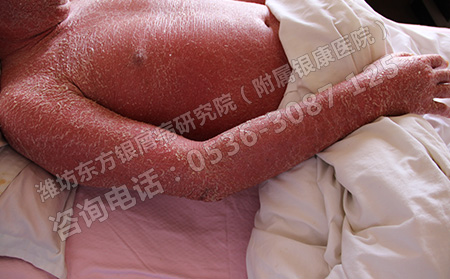 濰坊采用什么方法治療牛皮癬能夠使其更快的恢復(fù)呢