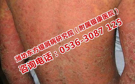 濰坊哪個醫(yī)院治療銀屑病可以