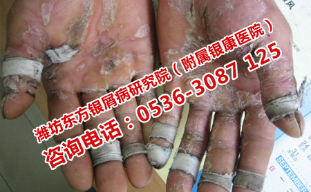 哪種方法治療牛皮癬顯著呢