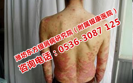如何擺脫牛皮癬的困擾