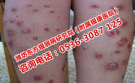 牛皮癬擴大和蔓延的原因是什么