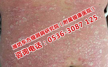 牛皮癬久治不愈怎么辦