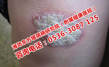 天氣潮濕怎樣預防牛皮癬加重