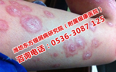 牛皮癬治療過程中加重怎么辦