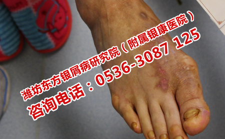 濰坊市口碑好的銀屑病醫院