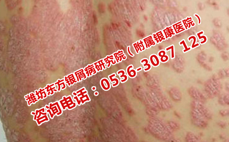 濰坊銀康醫(yī)院治治療效果果