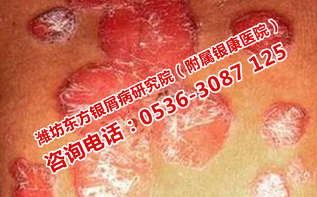 減少銀屑病復發的辦法