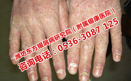昌樂銀屑病治療費用