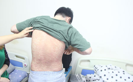 銀屑病應該怎么進行治療