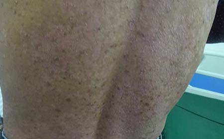 背部銀屑病癥狀,背部銀屑病癥狀圖片