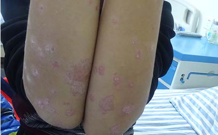 女性牛皮癬癥狀,女性有牛皮癬表現(xiàn)