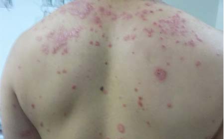 男性銀屑病癥狀,男性銀屑病什么樣