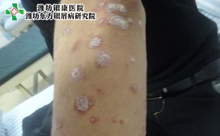 牛皮癬傳染,牛皮癬自身傳染嗎