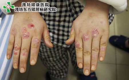 手部牛皮癬癥狀,手指牛皮癬癥狀表現(xiàn)