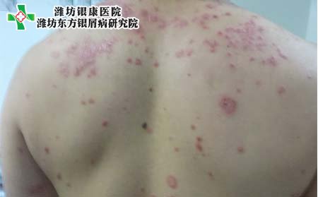 怎樣防治牛皮癬擴散,防治牛皮癬擴散方法