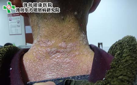 女性牛皮癬傳染,得牛皮癬傳染嗎