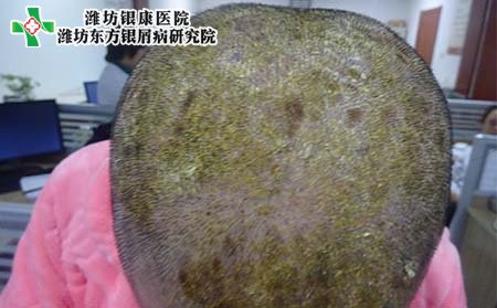頭部銀屑病癥狀,頭部銀屑病好轉表現