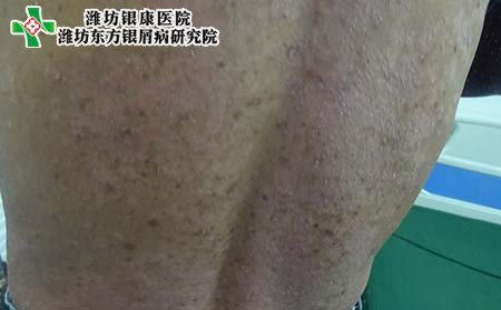 銀屑病癥狀表現(xiàn),怎樣判斷銀屑病癥狀
