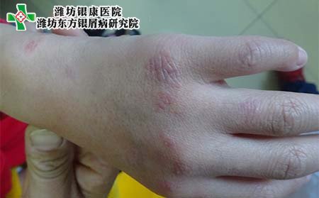 關節型牛皮癬癥狀,初期關節型牛皮癬癥狀