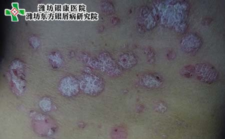 尋常型牛皮癬癥狀,尋常型牛皮癬有什么表現(xiàn)