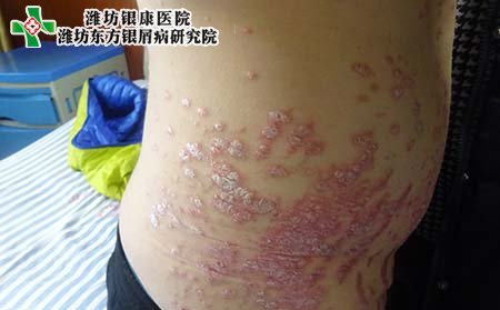 銀屑病癥狀,得銀屑病有什么癥狀