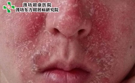 臉部牛皮癬癥狀,臉上牛皮癬什么表現