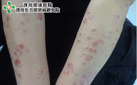 牛皮癬病因,兒童得牛皮癬的原因