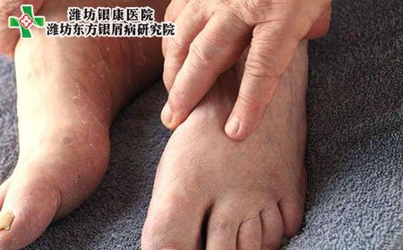濰坊銀屑病醫(yī)院教您如何通過腳部觀測銀屑病